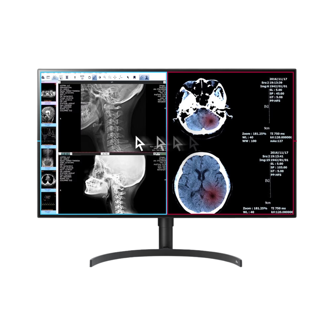Moniteur de diagnostic médical LG 32HL512D-B 32 pouces 8MP IPS, FDA 510K